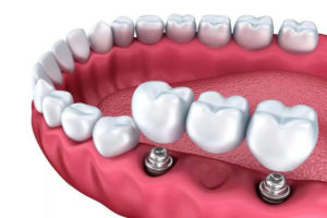 Implantologie Praha - Clinic+