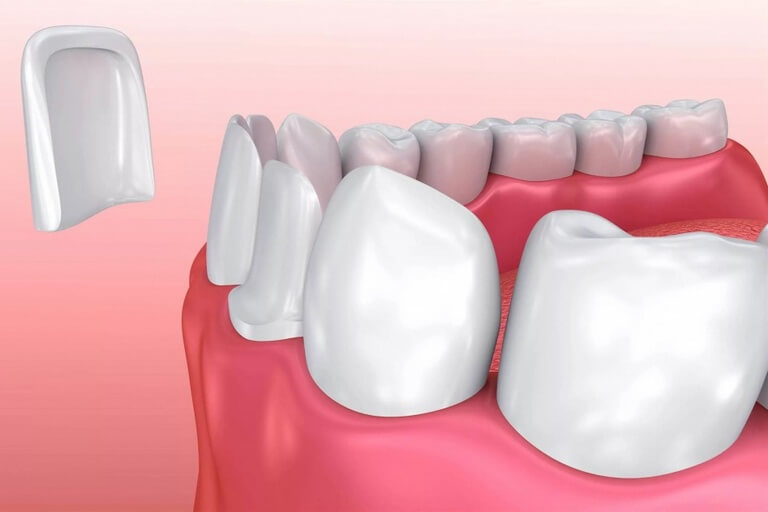 Keramická rekonstrukce zubů - Clinic+
