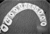 Dentální hygiena Praha - Zubní lékařství Praha 10 - Zubař Praha - Stomatologie Praha - 1 Způsoby léčení kořenových kanálků pomocí čepů - Zubař Praha 10