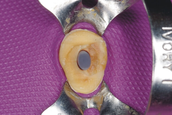 Dentální hygiena Praha - Zubní lékařství Praha 10 - Zubař Praha - Stomatologie Praha - 9 Způsoby léčení kořenových kanálků pomocí čepů - Zubař Praha 10 - Foto 9